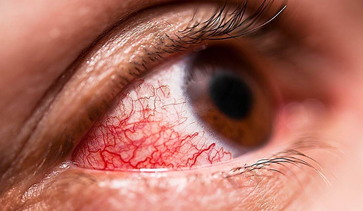 Diabētiskā retinopātija ir viena no vēlīnajām diabēta komplikācijām